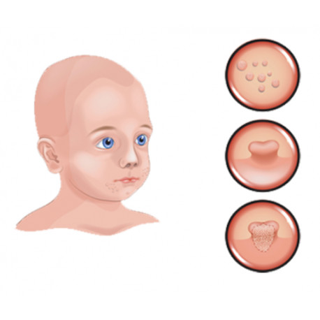 Molluscum contagiosum Pack Homéopathie Conseil