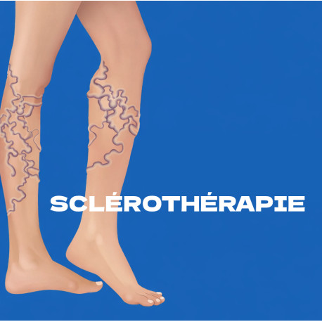 Sclérothérapie Pack Homéopathie Conseil